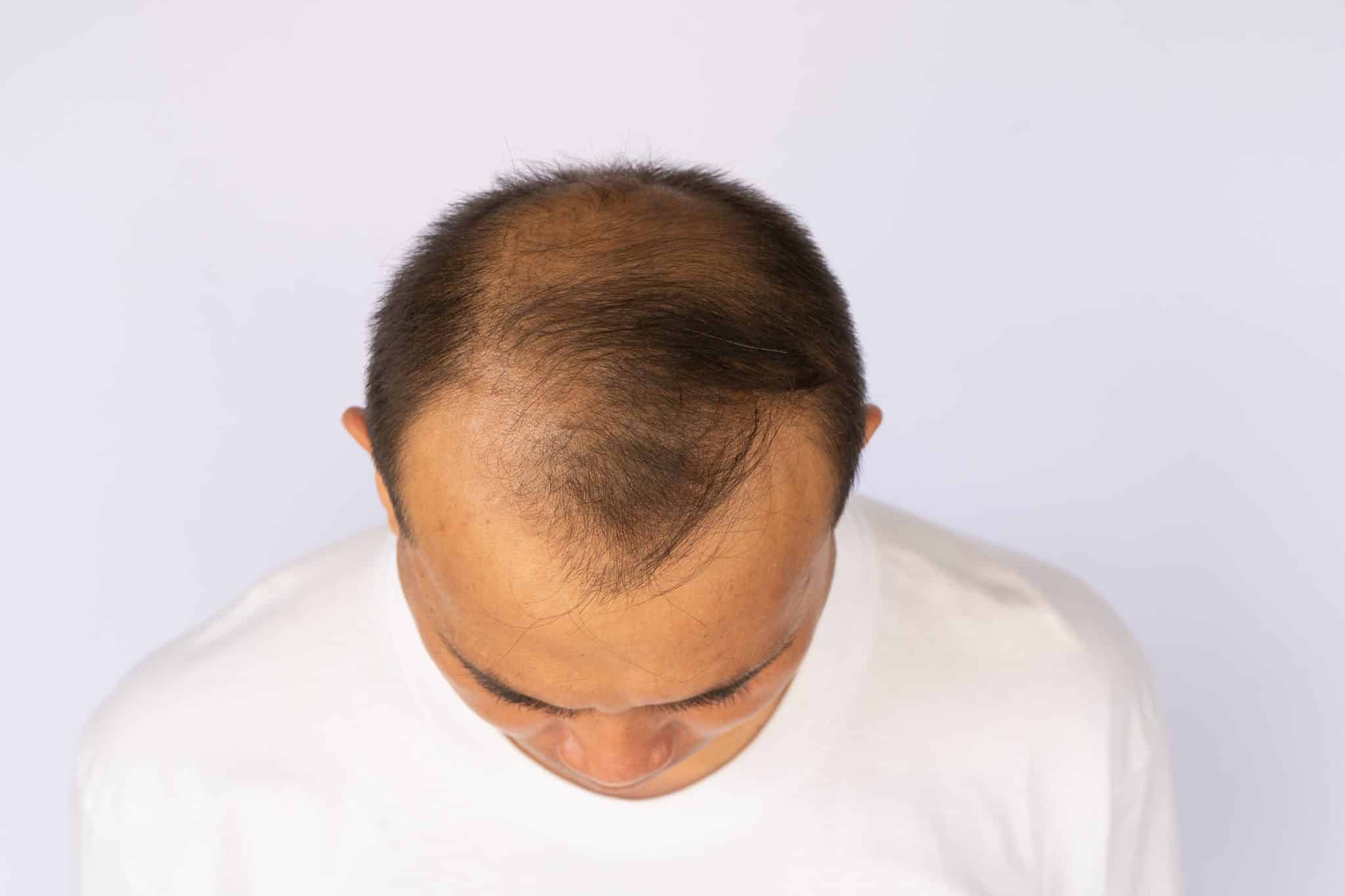 5 Treatments To Help With Hair Loss