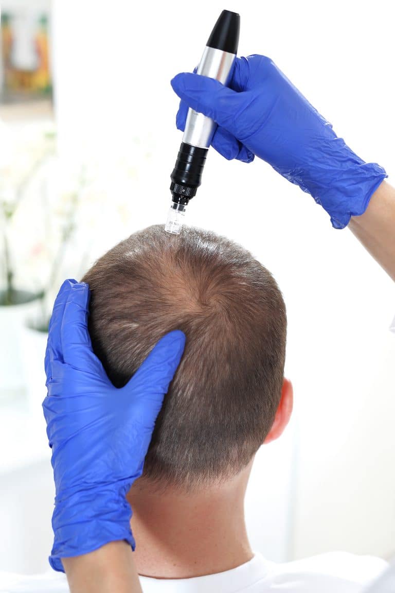How is Microneedling Conducted, and what to expect