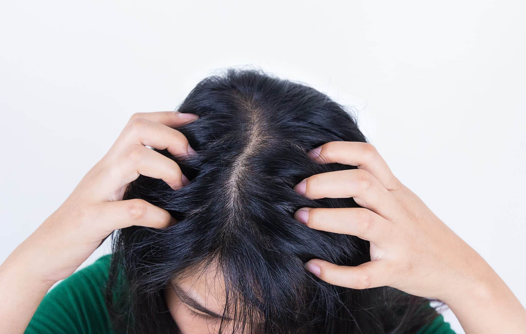 What-Causes-Dry-Scalp