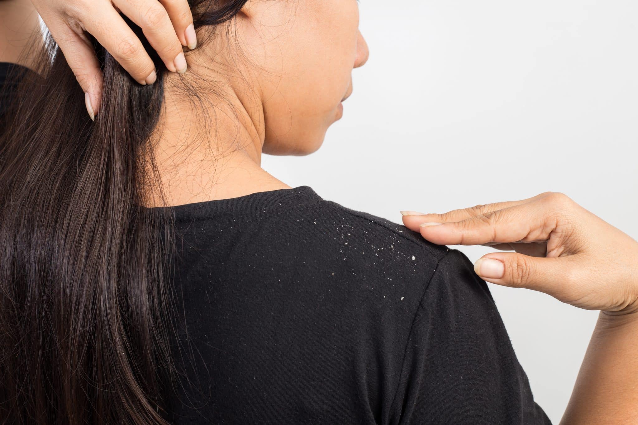 What causes dandruff