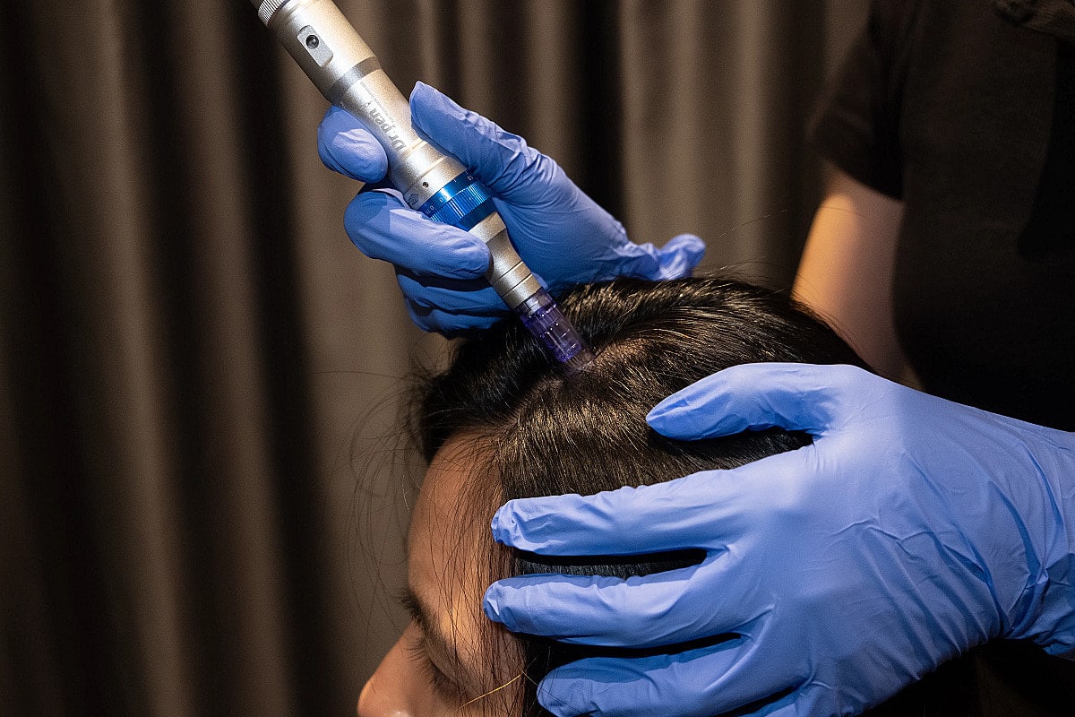 What is Microneedling