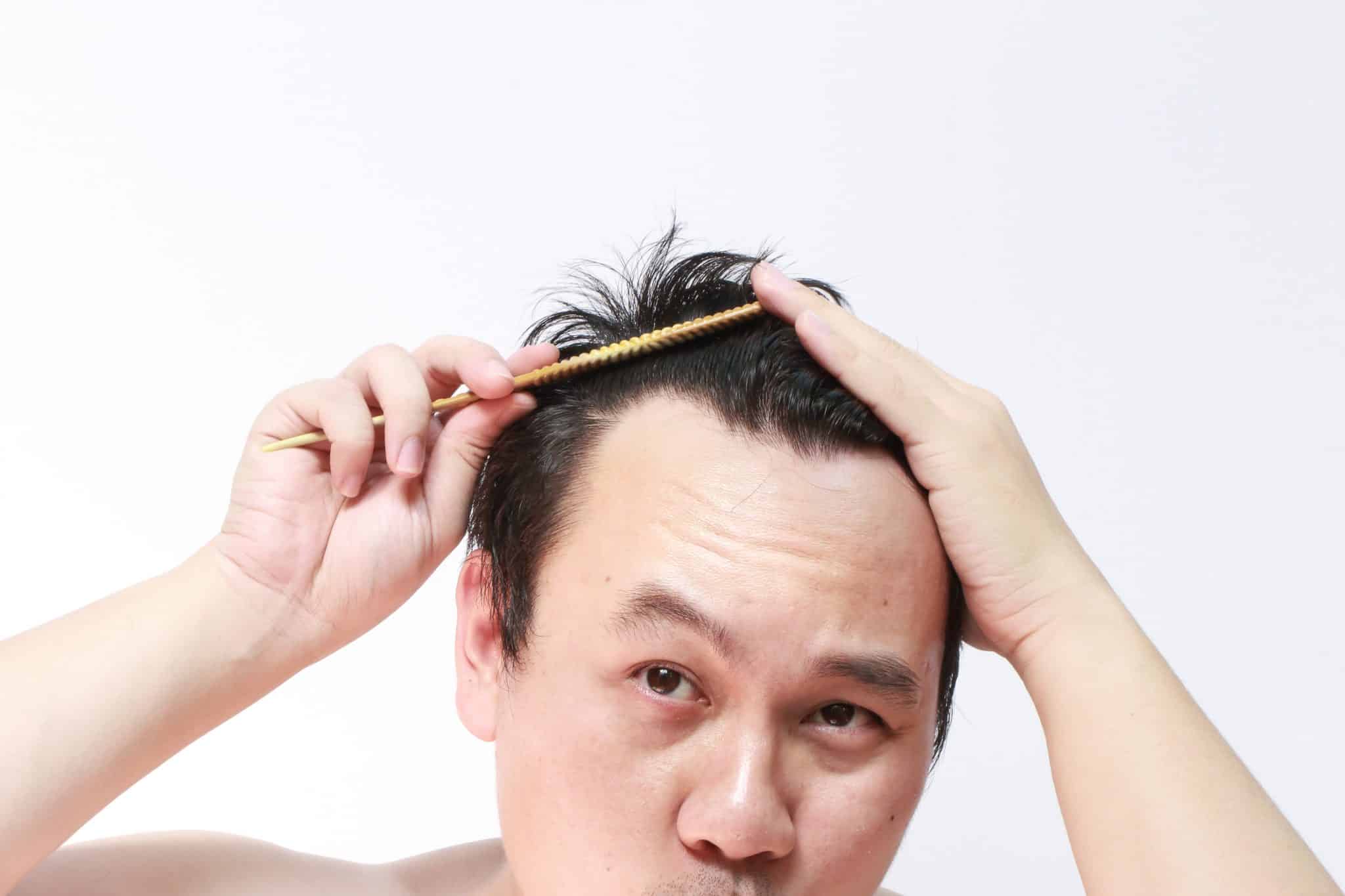 Is There A Link Between Itchy Scalp And Male Hair Loss