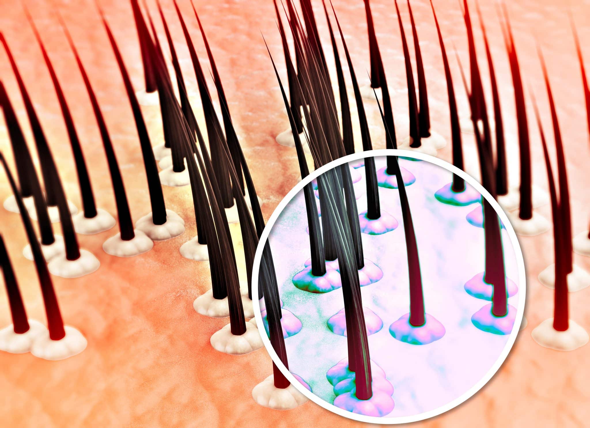 Scalp Psoriasis