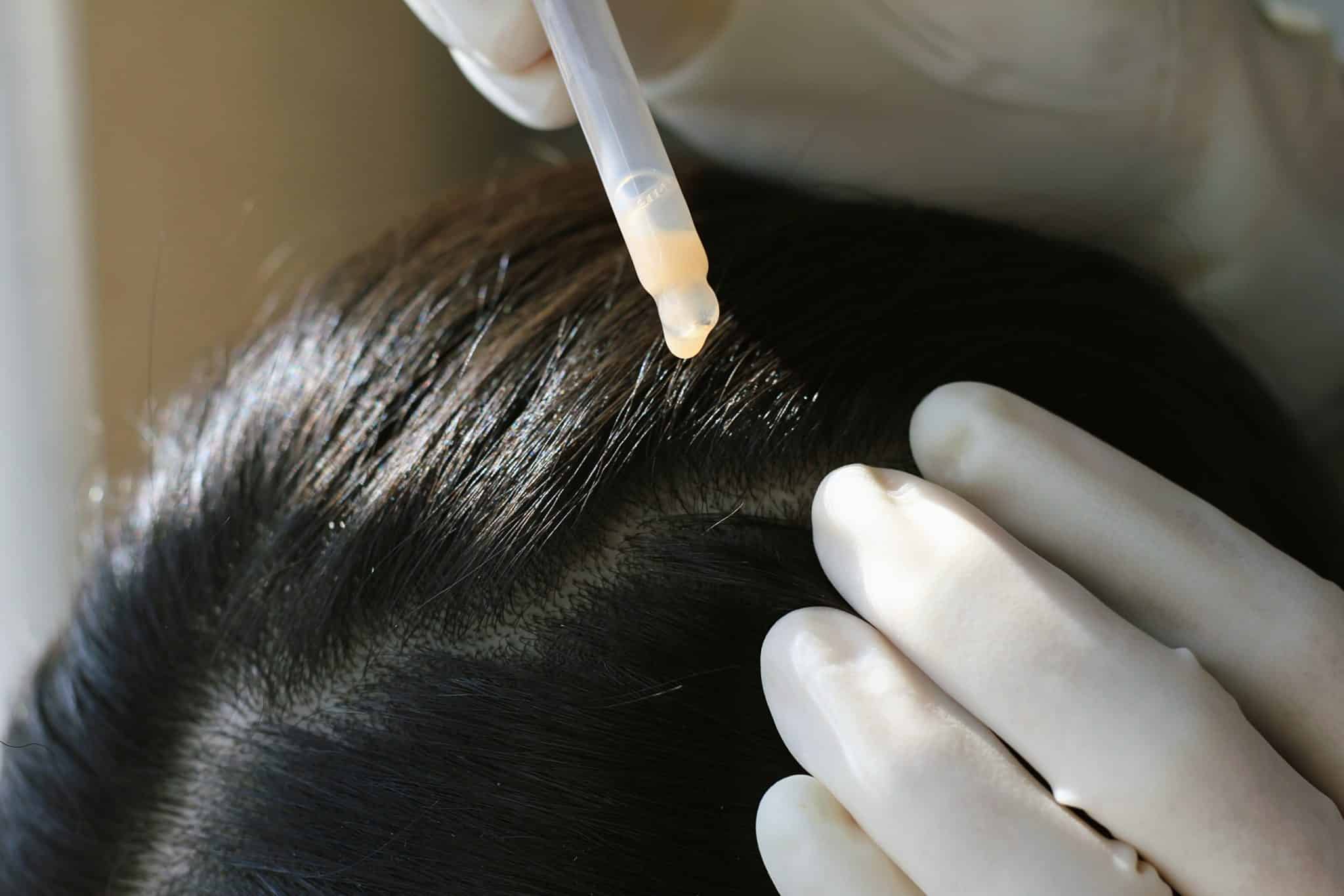 TrichoLab treatments for dandruff