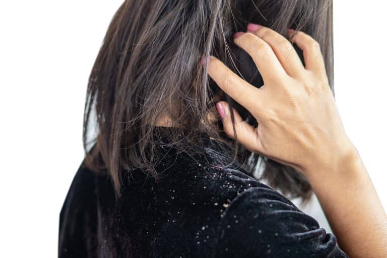 different types of dandruff