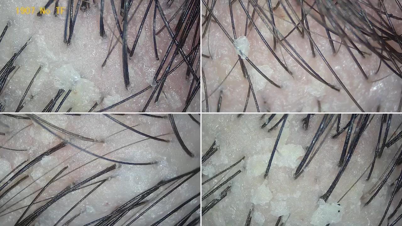 scalp flakes or scales