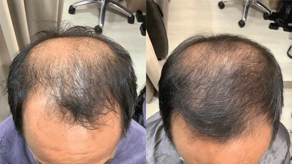 before and after male hair loss treatment