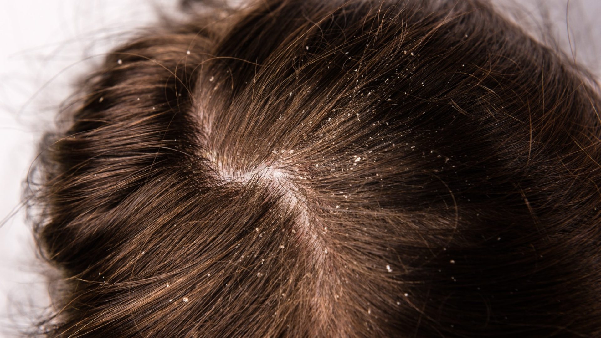 Demodex Scalp Treatment