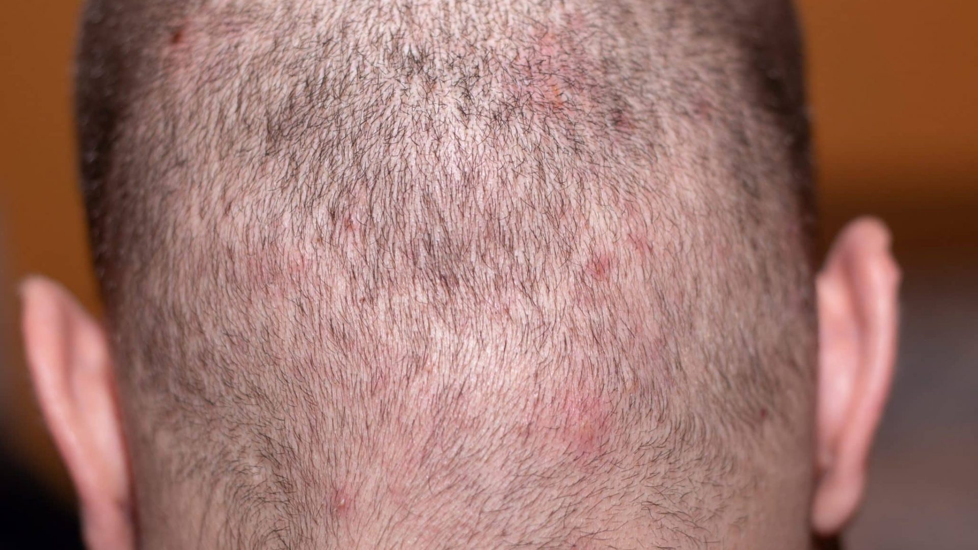 Back,View,Of,A,Bald,Man's,Head,With,Short,Hair