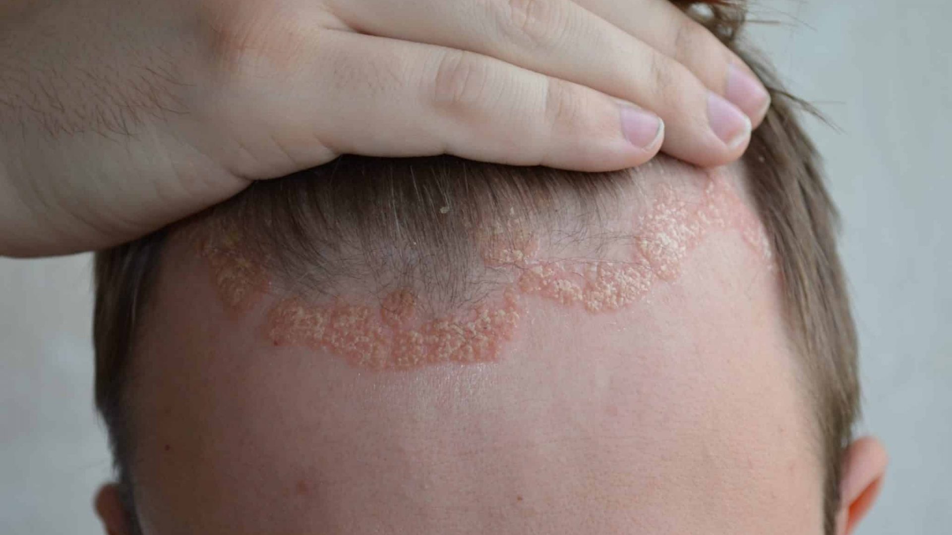 Psoriasis,On,The,Skin,Close-up,,Scalp,,Photos,Of,Dermatitis,And